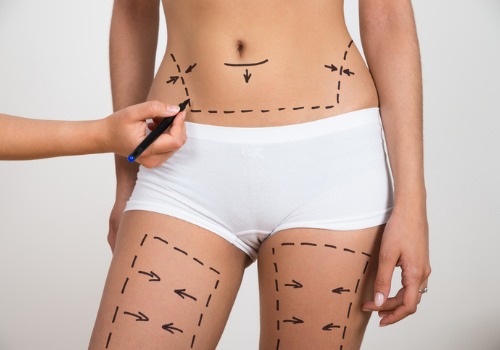 person-hand-drawing-lines-on-womans-abdomen-and-leg-picture-id513584484 person-hand-drawing-lines-on-womans-abdomen-and-leg-picture-id513584484